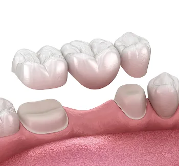 Dental Bridges