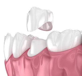 Dental Crowns