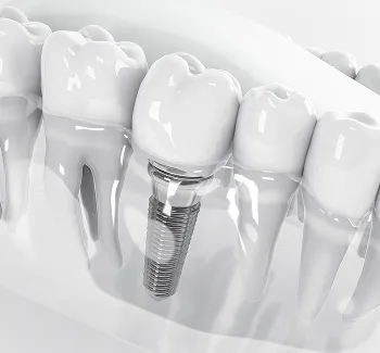 Implant Restoration